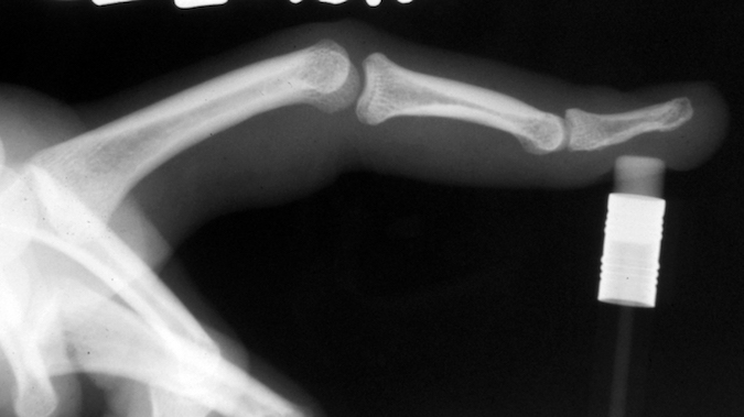 DISLOCATION, FINGER PROXIMAL INTERPHALANGEAL (PIP) JOINT | Hand Surgery
